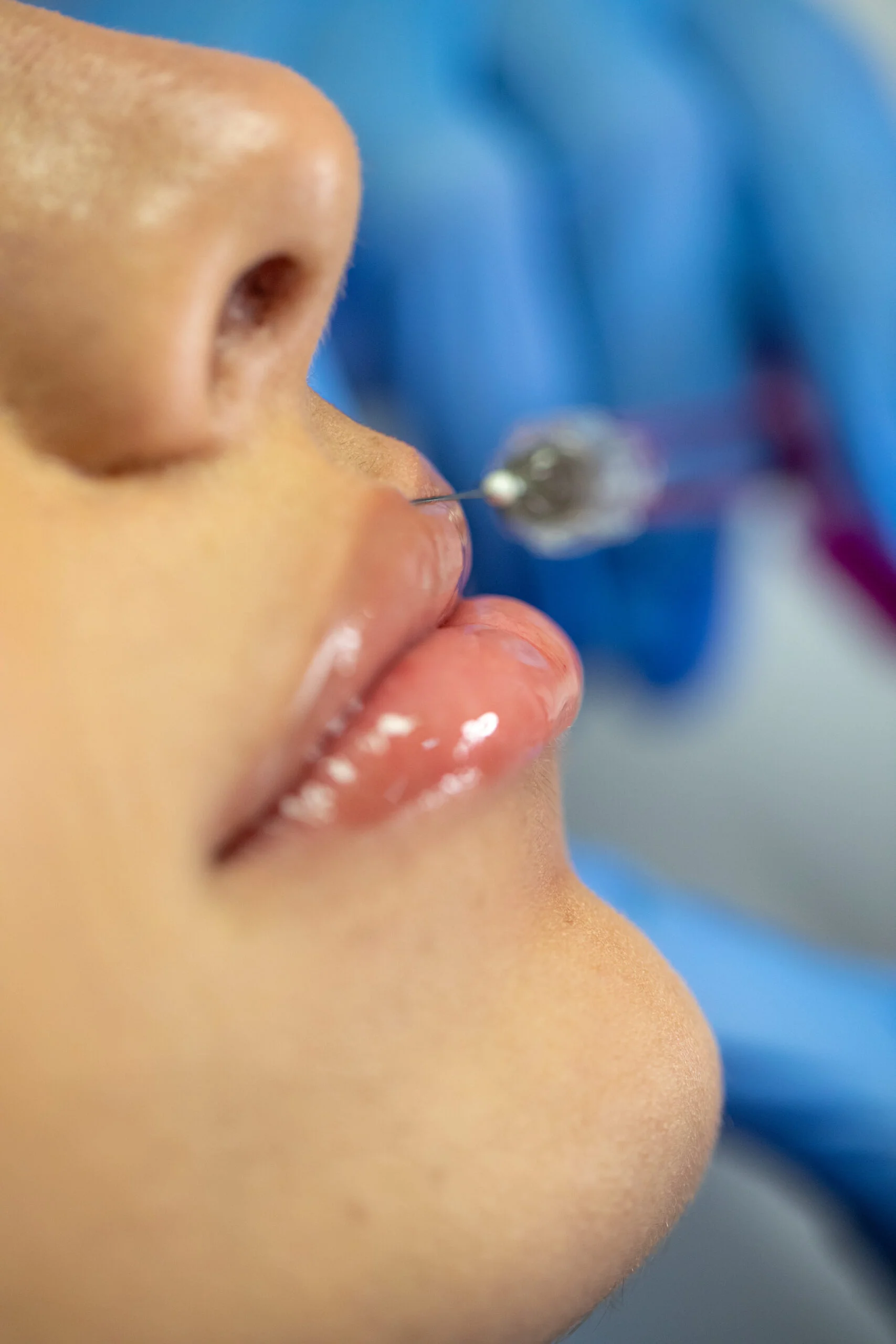Fillers in Houston